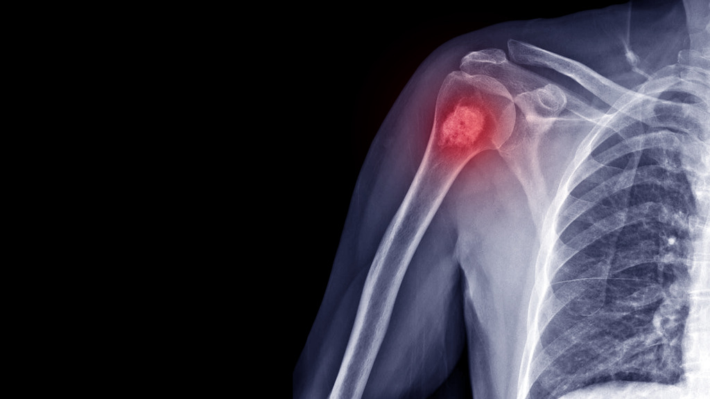diagnóstico de osteoporose