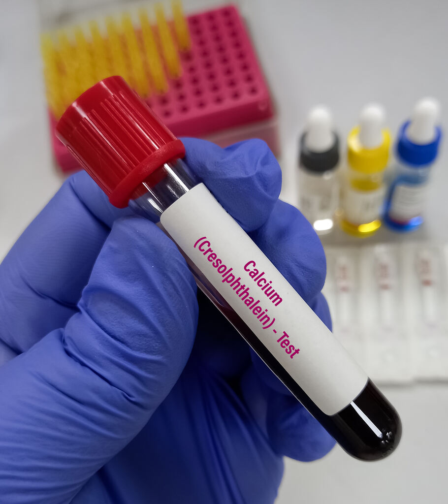 diagnostico hipocalcemia
