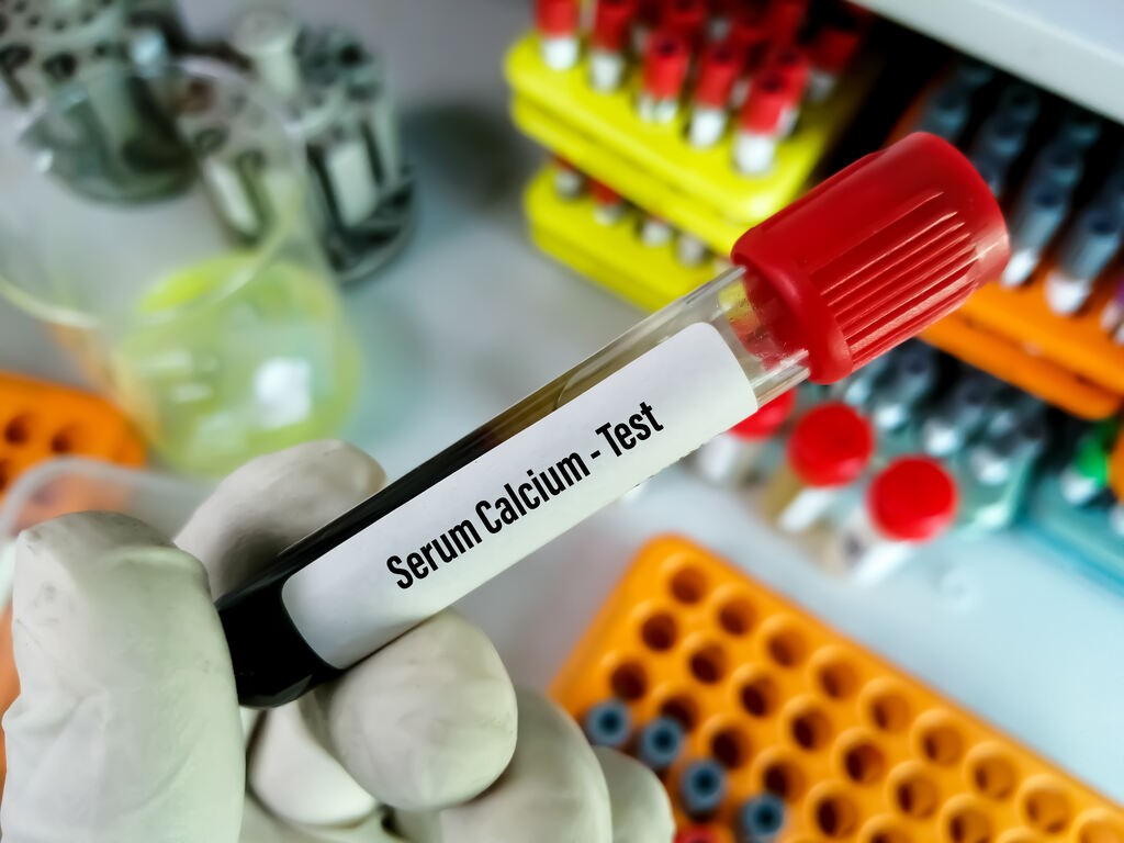 Exame de sangue para diagnóstico de hipercalcemia e avaliação dos níveis de cálcio sérico em laboratório clínico.