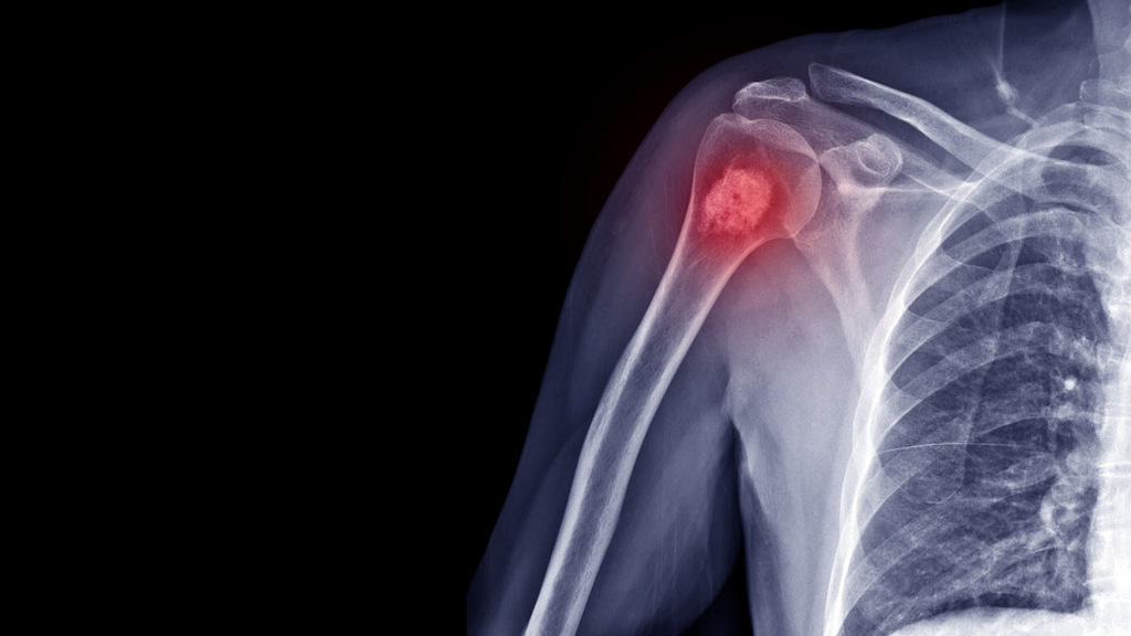 diagnistico osteoporose - Osteoporose pode virar câncer? Entenda de uma vez por todas qual a relação